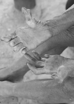Leprosy or Hansen's disease